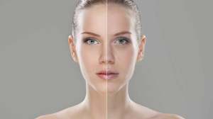 woman pre and post treatment